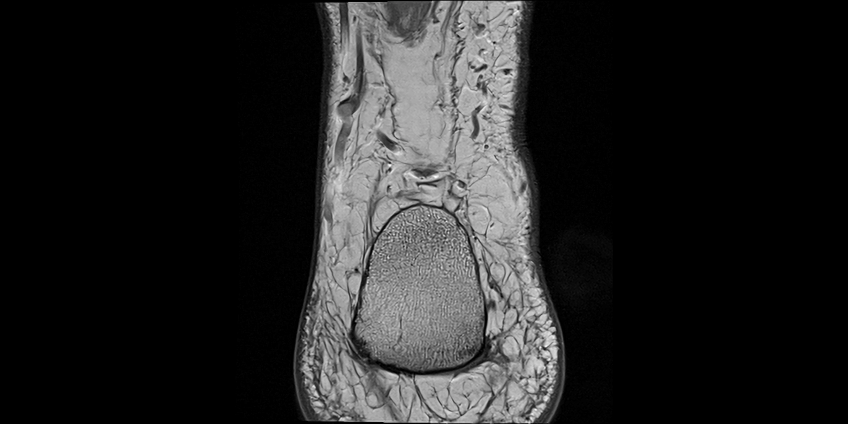 MRI Ankle coronal ligaments cross sectional anatomy 3T  radiology  image-img-00001-00027.webp